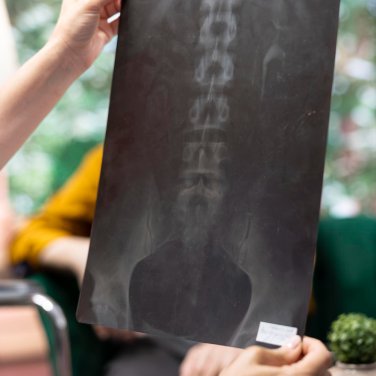 BSPTS (Barselona Skolyoz Fizik Tedavi Okulu) Schroth Yöntemi