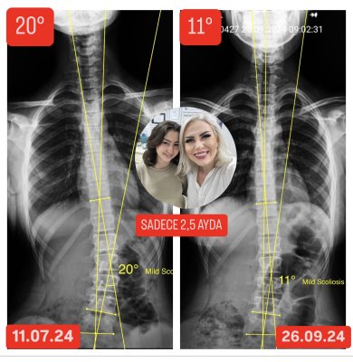 RAVZA BALCI'NIN SKOLYOZU 2.5 AYDA 9 DERECE GERİLEDİ!