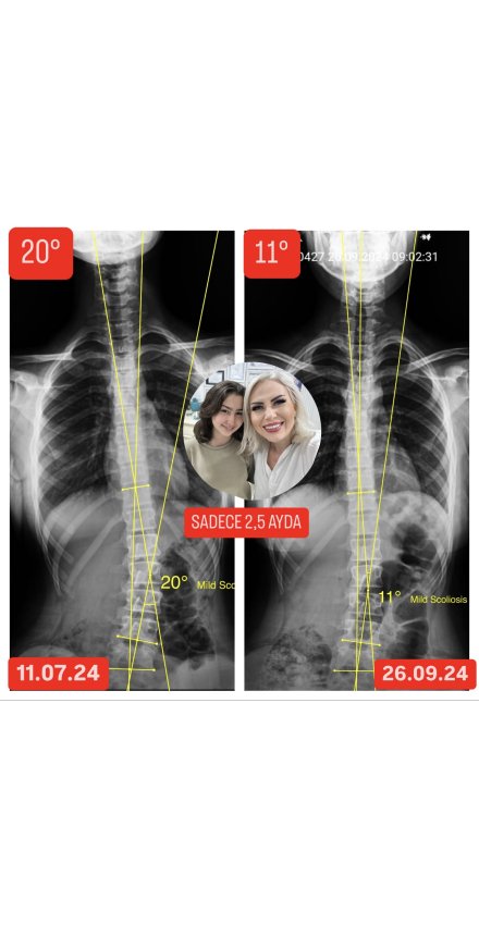RAVZA BALCI'NIN SKOLYOZU 2.5 AYDA 9 DERECE GERİLEDİ!