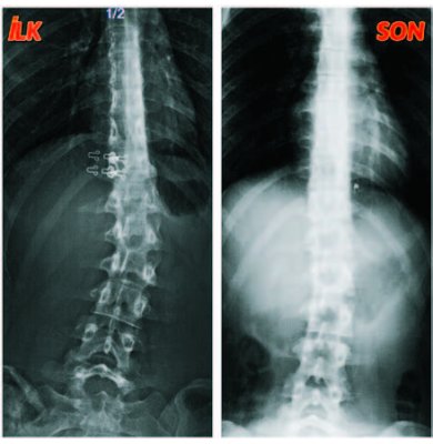 MISBAH NUR BAŞARAN: Skolyozum 2 ayda 10 derece geriledi