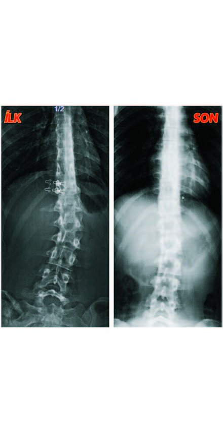 MISBAH NUR BAŞARAN: Skolyozum 2 ayda 10 derece geriledi MISBAH NUR BAŞARAN: Skolyozum 2 ayda 10 derece geriledi
