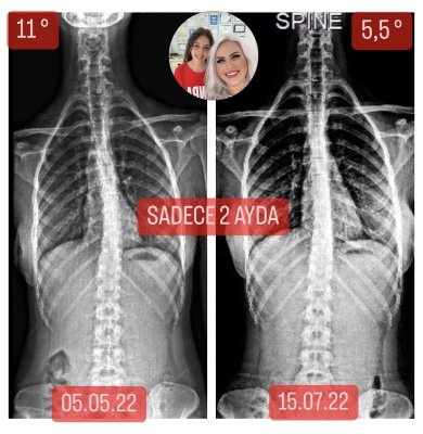 Ceren Işıkçı: Skolyozum 2 ayda 6,5 derece geriledi