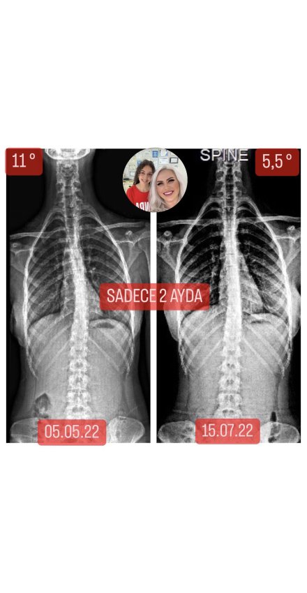 Ceren Işıkçı: Skolyozum 2 ayda 6,5 derece geriledi Ceren Işıkçı: Skolyozum 2 ayda 6,5 derece geriledi