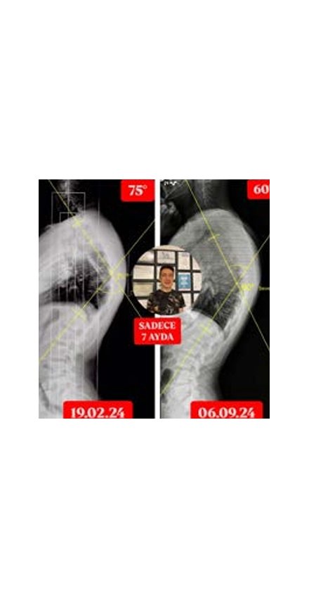 KİFOZU 75 DERECEDEN 60 DERECEYE GERİLEDİ KİFOZU 75 DERECEDEN 60 DERECEYE GERİLEDİ