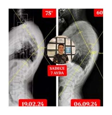 KİFOZU 75 DERECEDEN 60 DERECEYE GERİLEDİ