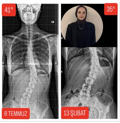 BETÜL YAVUZ'UN SKOLYOZU 23 YAŞINDA 6 DERECE GERİLEDİ!