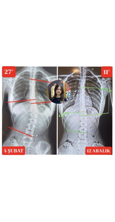MELEK ÖMÜR ÖNER'İN 16 YAŞINDA SKOLYOZ AÇISI 16 DERECE GERİLEDİ!