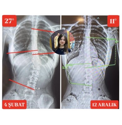 MELEK ÖMÜR ÖNER'İN 16 YAŞINDA SKOLYOZ AÇISI 16 DERECE GERİLEDİ!