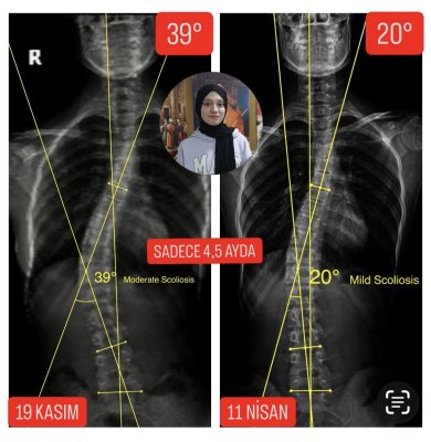 ZEYNEP HAFSA DÖNMEZ'İN SKOLYOZU 19 DERECE GERİLEDİ!