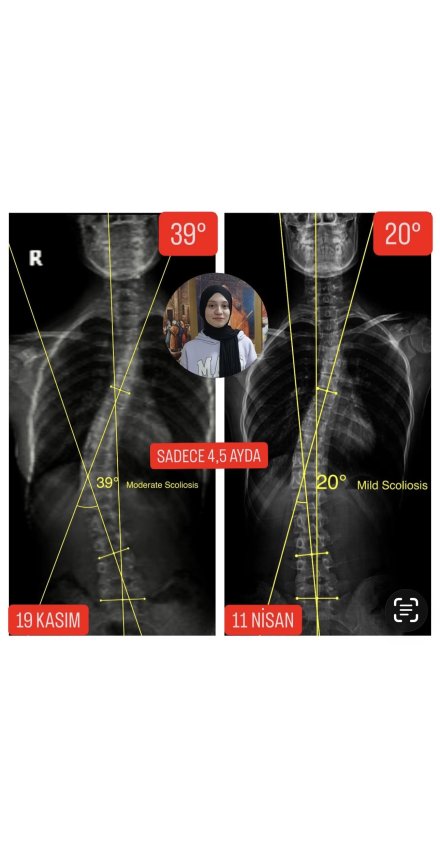 ZEYNEP HAFSA DÖNMEZ'İN SKOLYOZU 19 DERECE GERİLEDİ!