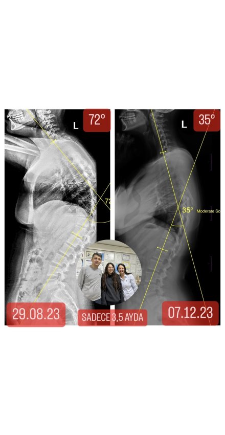 YAĞMUR TOPRAK'IN KİFOZU 3,5 AYDA 37 DERECE AZALDI