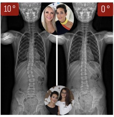 TÜRKAN CENGİZ'İN 10 YAŞINDA SKOLYOZU TAMAMEN SIFIRLANDI!