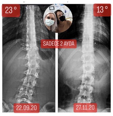 MISBAH NUR BAŞARAN: Skolyozum 2 ayda 10 derece geriledi
