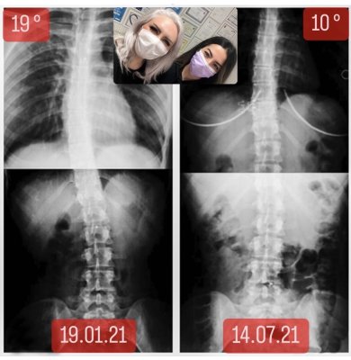 CANSU NURAY KAHRAMAN: SKOLYOZUM 9 DERECE AZALDI