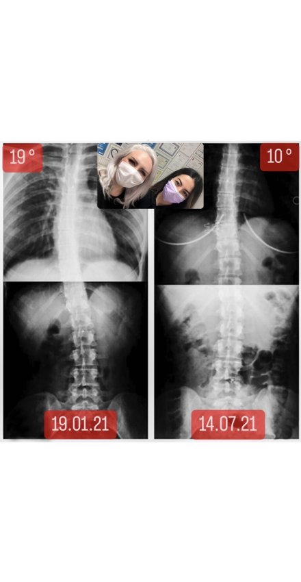CANSU NURAY KAHRAMAN: SKOLYOZUM 9 DERECE AZALDI