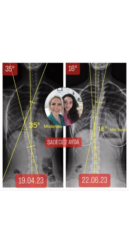 İREM YILMAZ'IN 17 YAŞINDA SKOLYOZU 19 DERECE GERİLEDİ!