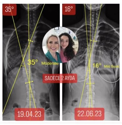İREM YILMAZ'IN 17 YAŞINDA SKOLYOZU 19 DERECE GERİLEDİ!