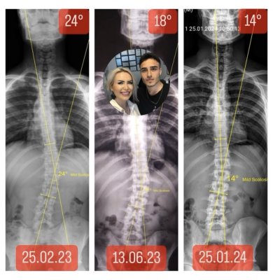 BURAK BOLAT'IN SKOLYOZU 10 DERECE GERİLEDİ!