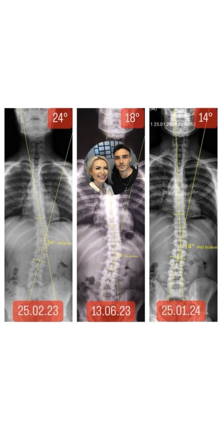 BURAK BOLAT'IN SKOLYOZU 10 DERECE GERİLEDİ!