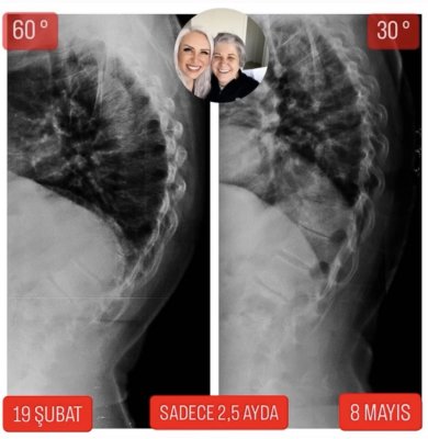 63 YAŞINDA SEMRA ÇAĞLAR'IN KİFOZU 30 DERECE GERİLEDİ!