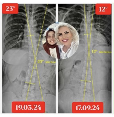 26 YAŞINDA İLKNUR ÖZER'İN SKOLYOZU 23 DERECEDEN 12 DERECEYE GERİLEDİ!