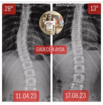 14 YAŞINDA AYŞENAZ SEVİM'İN SKOLYOZU 15 DERECE GERİLEDİ!