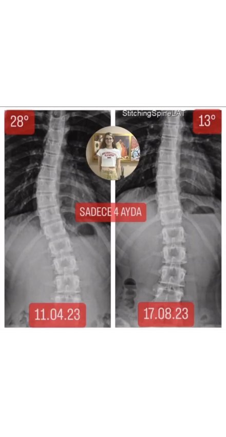 14 YAŞINDA AYŞENAZ SEVİM'İN SKOLYOZU 15 DERECE GERİLEDİ!