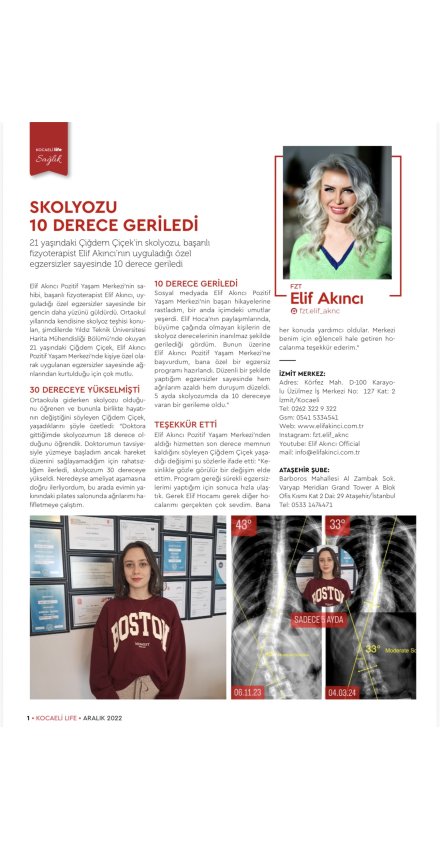 21 YAŞINDA ÇİĞDEM ÇİÇEK'İN SKOLYOZU 10 DERECE GERİLEDİ!
