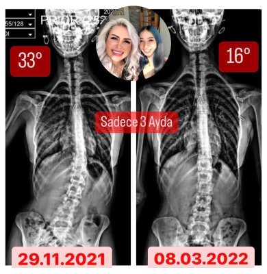 GÖNÜL YÜZSEVEN: 23 YAŞIMDA SKOLYOZUM 3 AYDA 17 DERECE GERİLEDİ