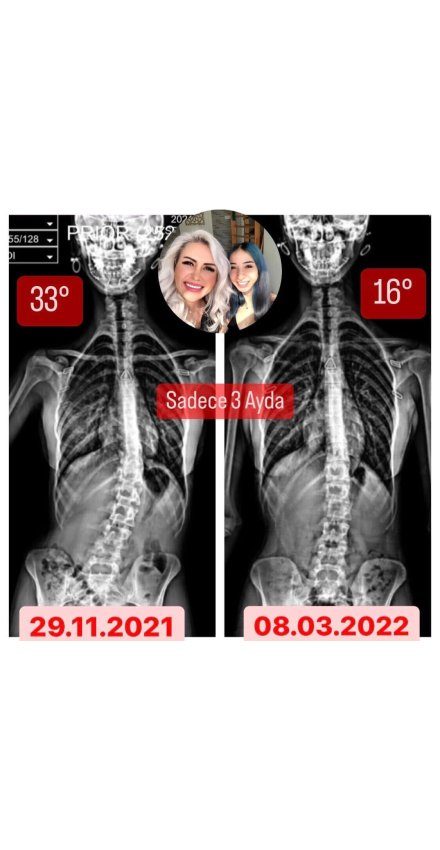 GÖNÜL YÜZSEVEN: 23 YAŞIMDA SKOLYOZUM 3 AYDA 17 DERECE GERİLEDİ