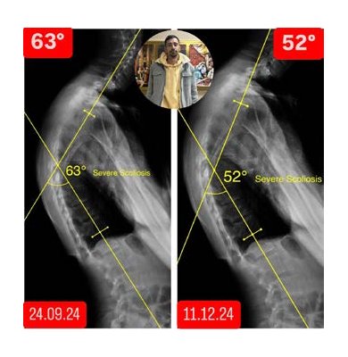 Skolyozu 9, Kifozu 11 Derece Geriledi