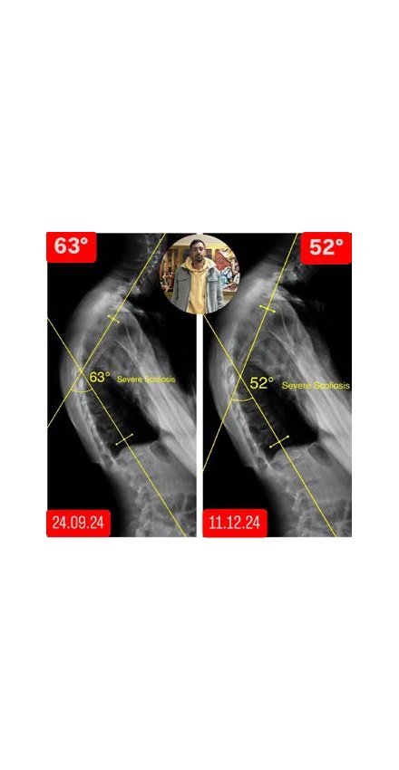 Skolyozu 9, Kifozu 11 Derece Geriledi Skolyozu 9, Kifozu 11 Derece Geriledi