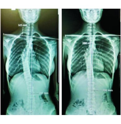 ZEYNEP BEYZA GÜNDOĞDU: SKOLYOZUM 3 AYDA 12 DERECE GERİLEDİ