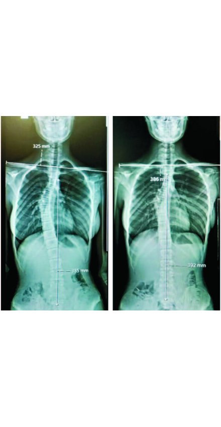 ZEYNEP BEYZA GÜNDOĞDU: SKOLYOZUM 3 AYDA 12 DERECE GERİLEDİ