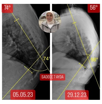 64 YAŞINDA ÜMMÜHAN ÖZGÜR'ÜN KİFOZU 18 DERECE VE SKOLYOZU15 DERECE GERİLEDİ