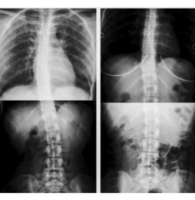 Fizyoterapist Elif Akıncı ile Başarı Hikayesi