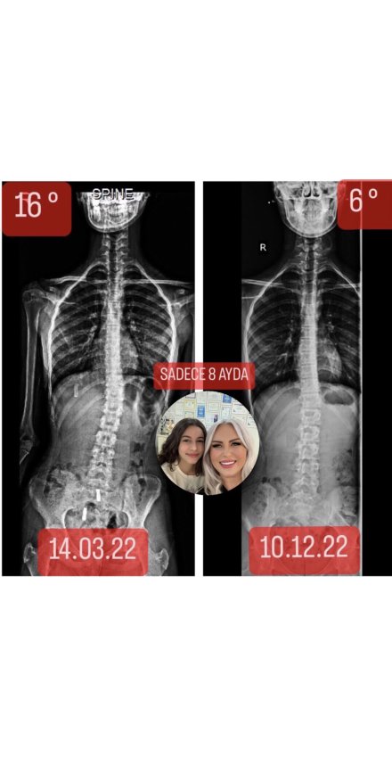 Nehir Özal: Skolyozum  16°’den 6°’ye Geriledi