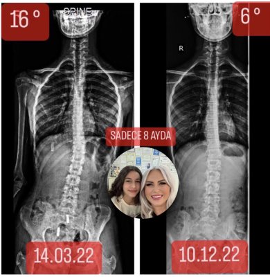Nehir Özal: Skolyozum  16°’den 6°’ye Geriledi